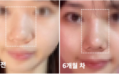 6개월만에 코 예뻐지는 법(+비수술 교정방법,시술x)